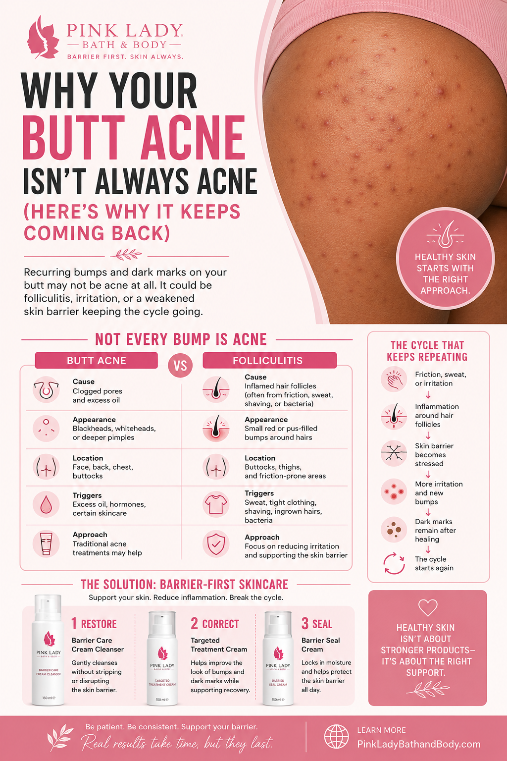 Why Your Butt Acne Isn't Always Acne (Here's Why It Keeps Coming Back)