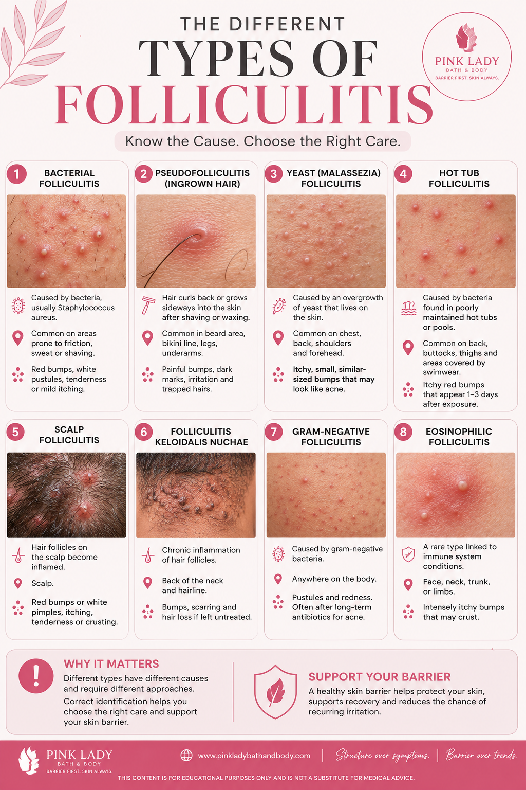 Types of Folliculitis: How to Tell the Difference (And Why It Matters)